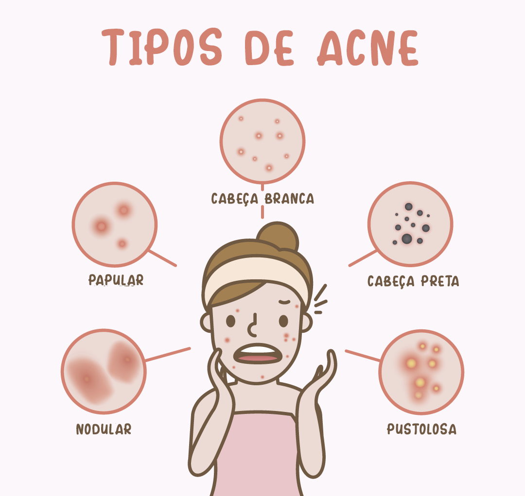 acne em adultos